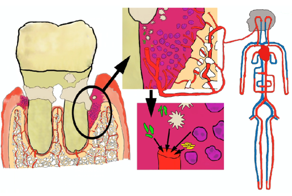 Illustrasjon av forekomst av periodontitt