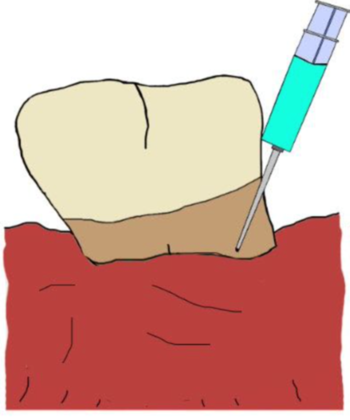 Illustration on Non-surgical treatment with enamel matrix derivative 