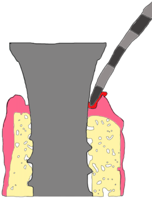 Illustrasjon av peri-implantat mukositt